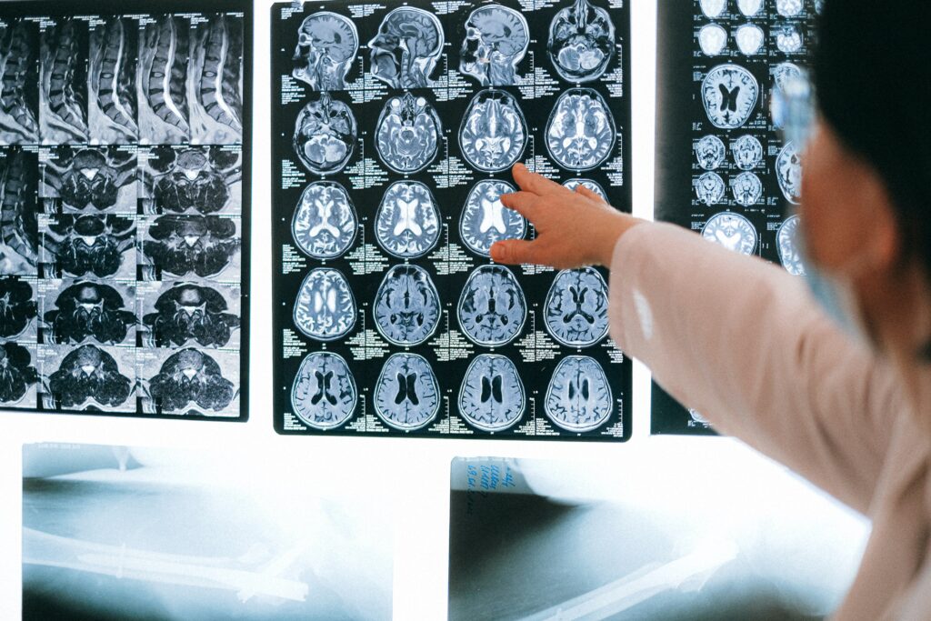 how does epilepsy affect the brain