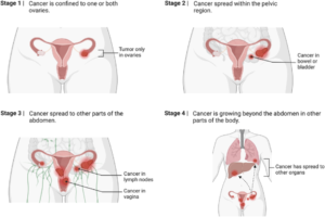 Ovarian cancer training spread