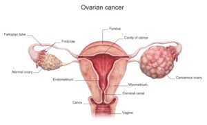 Ovarian cancer training1